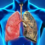 COPD - BCN Health