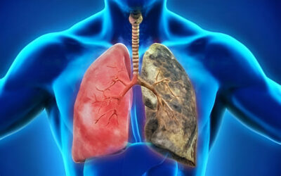 COPD - BCN Health